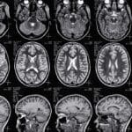 Traumatic brain injury MRI
