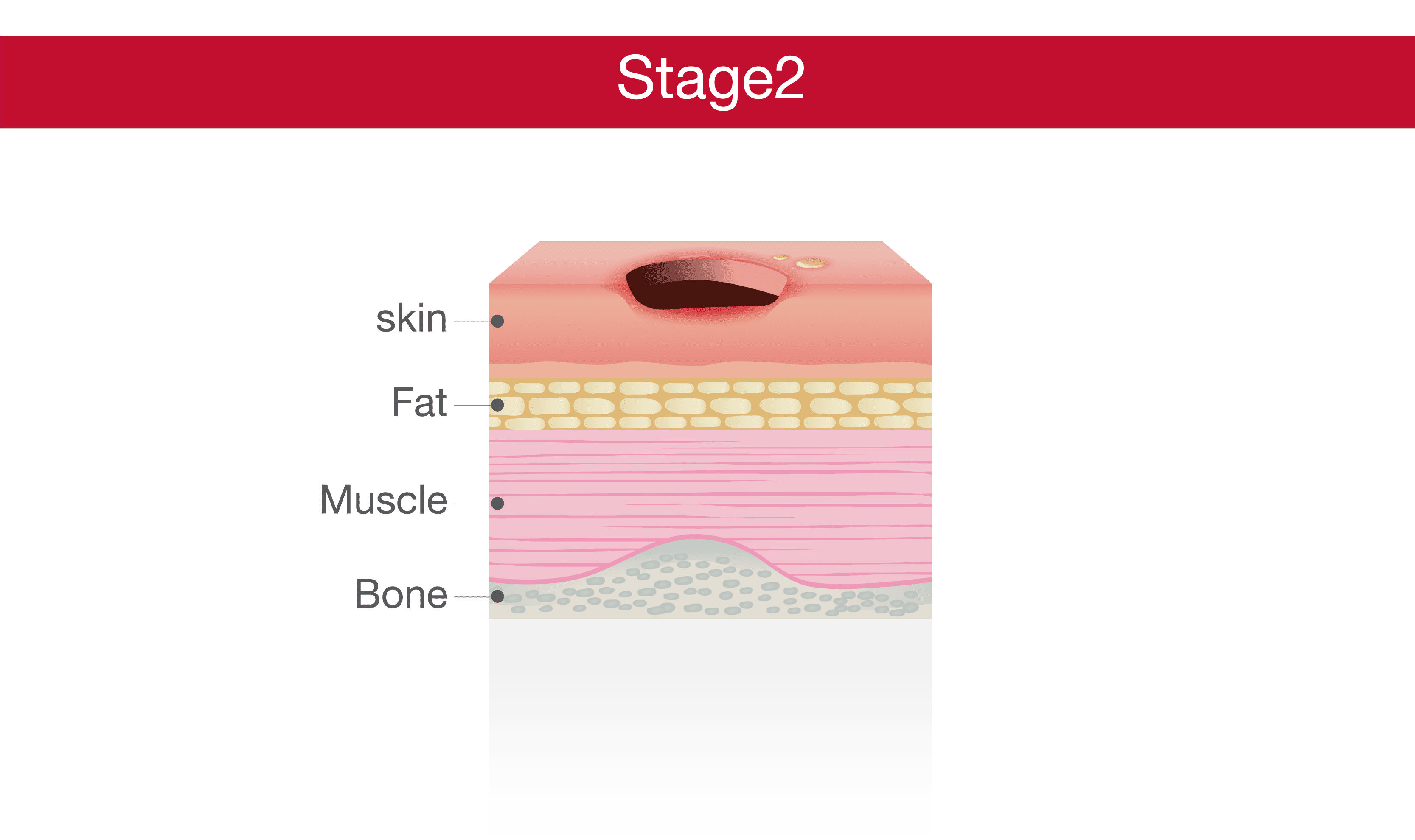 Bedsore Stage 2 - Shallow Ulcer