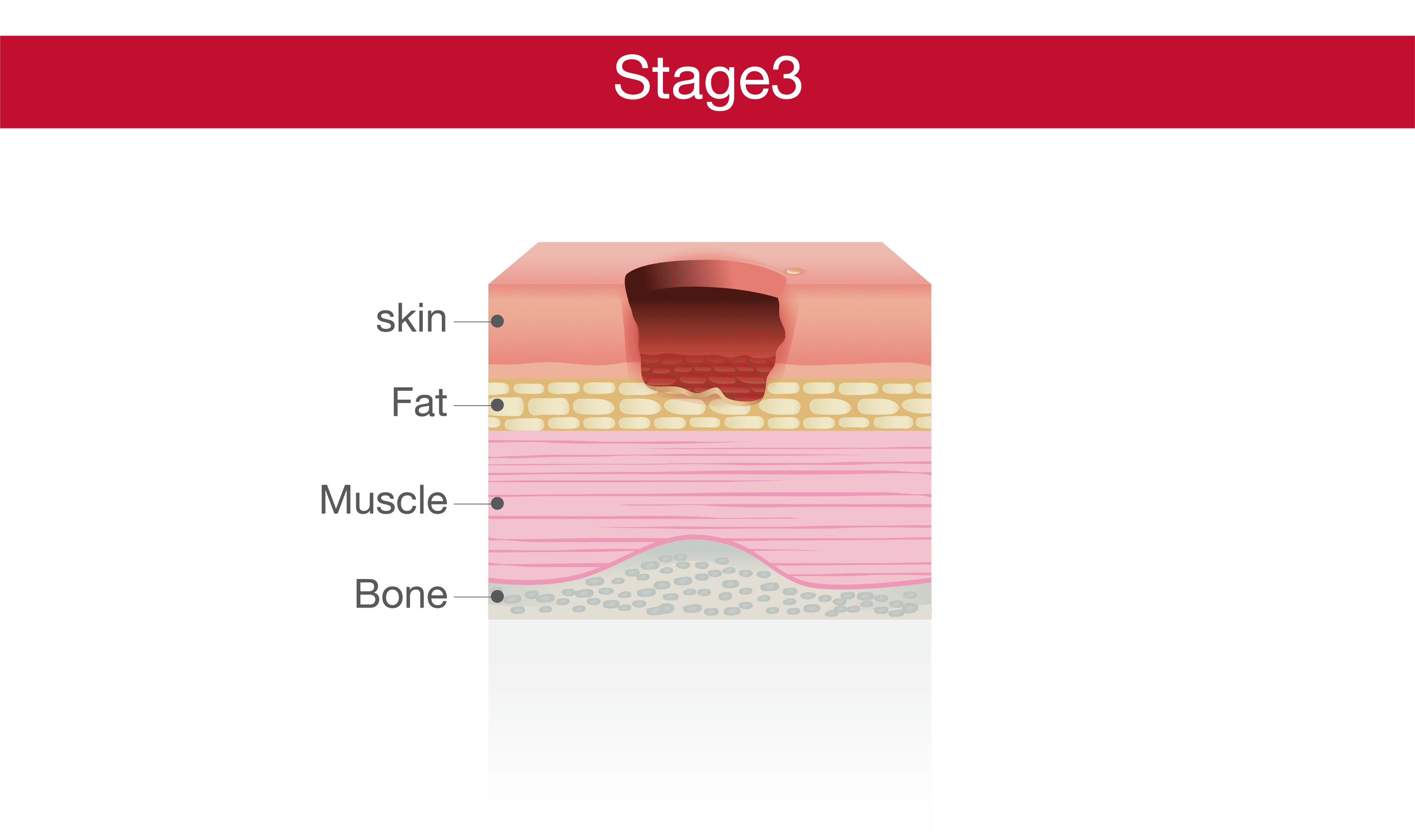 Bedsore Stage 3 - Deep Ulcer